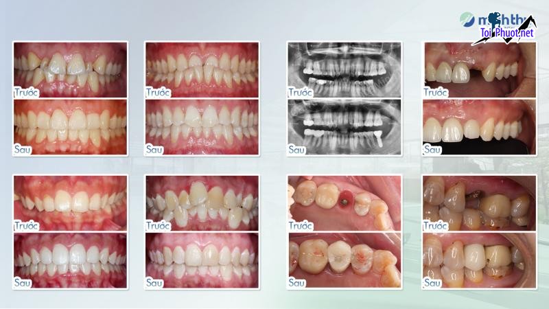 Top 15 Phòng khám nha khoa tốt nhất tại Hà Nội trình độ chuyên môn cao (2)