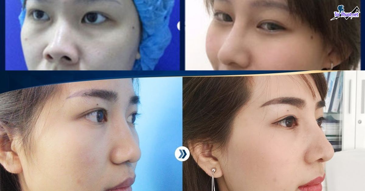 Top 10 Địa chỉ nâng mũi đẹp và an toàn nhất Bắc Giang công nghệ cao (5)