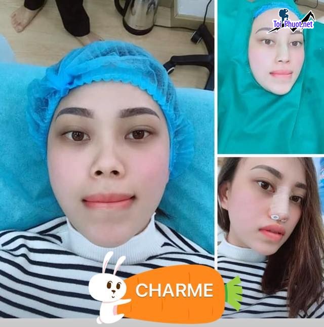 Top 12 Địa chỉ nâng mũi đẹp và an toàn nhất Yên Bái công nghệ nâng mũi tiên tiến nhất (6)