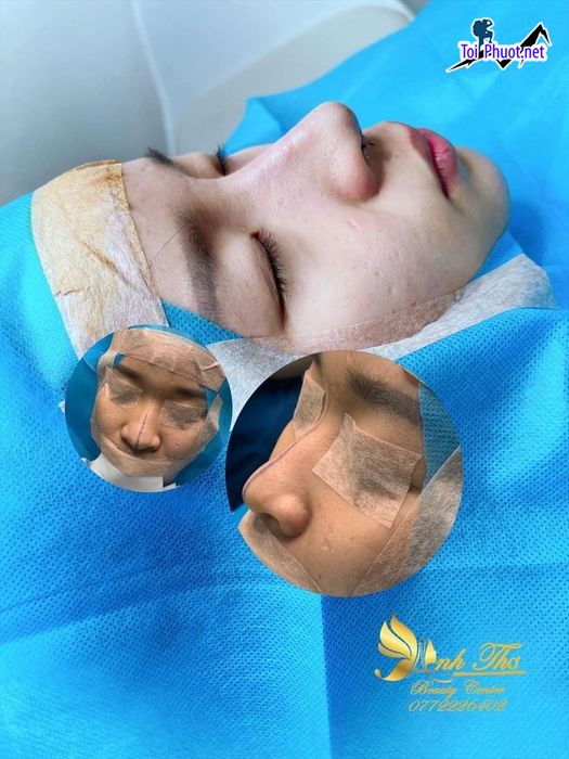 Top 3 Địa chỉ Đông Hà Quảng Trị nâng mũi đẹp và an toàn nhất nhiều chị em tin tưởng (1)