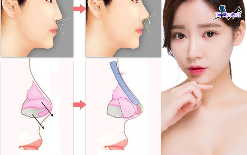 Top 3 Địa chỉ nâng mũi đẹp và an toàn nhất Trà Vinh được đánh giá cao (2)