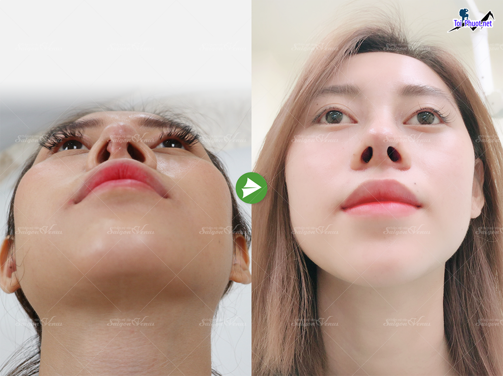 Top 3 Địa chỉ nâng mũi đẹp và an toàn nhất Vĩnh Long tin tưởng tuyệt đối (1)