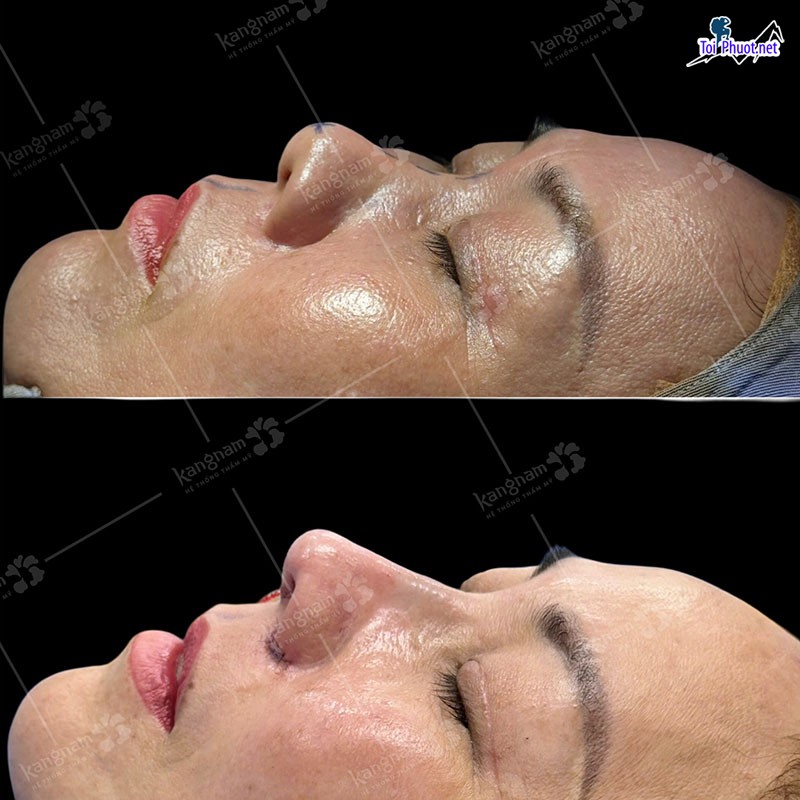 Top 5 Địa chỉ nâng mũi Cần Thơ đẹp và an toàn nhất (1)