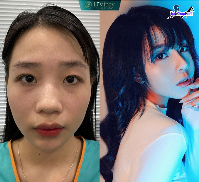 Top 5 Địa chỉ nâng mũi đẹp Mỹ Tho Tiền Giang và an toàn nhất thẩm mỹ cao (1)