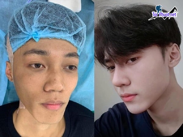 Top 5 Địa chỉ nâng mũi đẹp Mỹ Tho Tiền Giang và an toàn nhất thẩm mỹ cao (2)