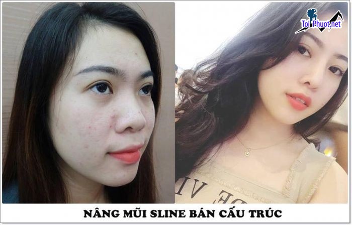 Top 8 Địa chỉ nâng mũi đẹp Hồ Chí Minh và an toàn nhất làm hài lòng nhất (2)