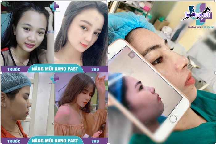 Top 8 Địa chỉ nâng mũi đẹp Hồ Chí Minh và an toàn nhất làm hài lòng nhất (4)