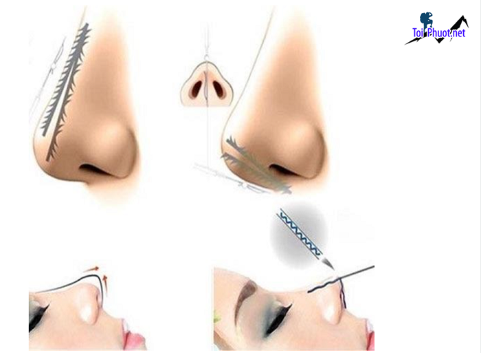 Top 8 Địa chỉ nâng mũi đẹp và an toàn nhất Hải Phòng chi phí cực rẻ (1)