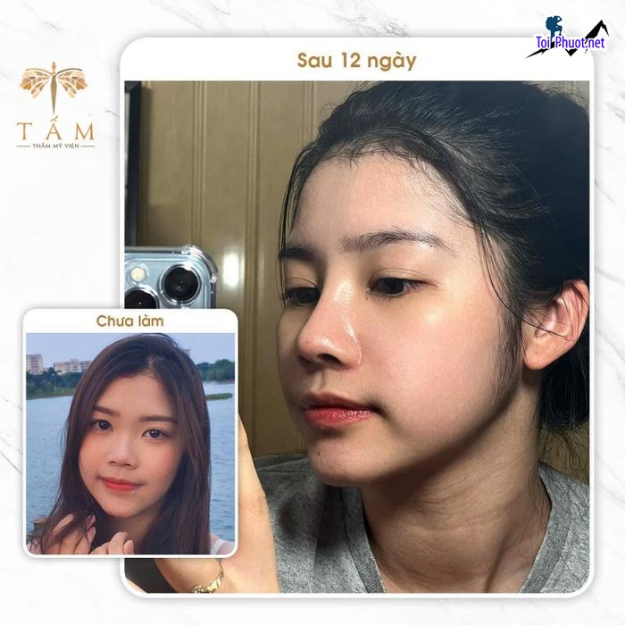 Top 8 Địa chỉ nâng mũi đẹp và an toàn nhất Thanh Hóa theo tiêu chuẩn y tế (1)