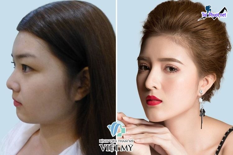 Top Địa chỉ Vĩnh Yên Vĩnh Phúc nâng mũi đẹp và an toàn nhất chuyên sâu (1)