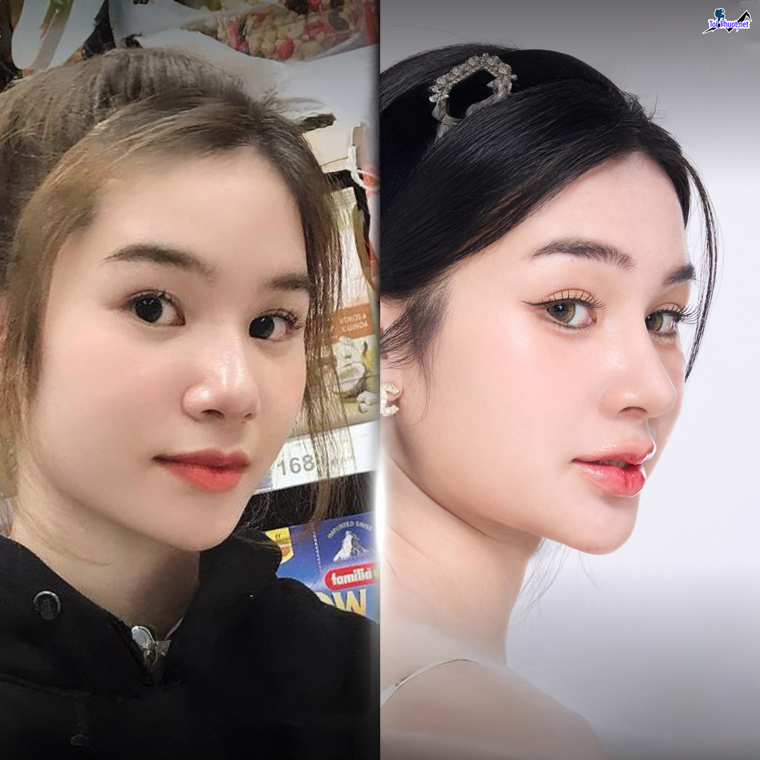 Top Địa chỉ Vĩnh Yên Vĩnh Phúc nâng mũi đẹp và an toàn nhất chuyên sâu (1)