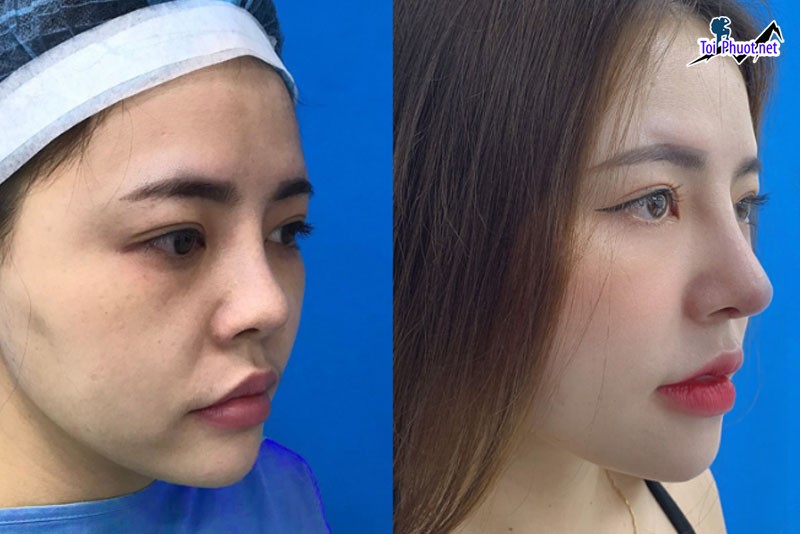 Top Địa chỉ Vĩnh Yên Vĩnh Phúc nâng mũi đẹp và an toàn nhất chuyên sâu (2)