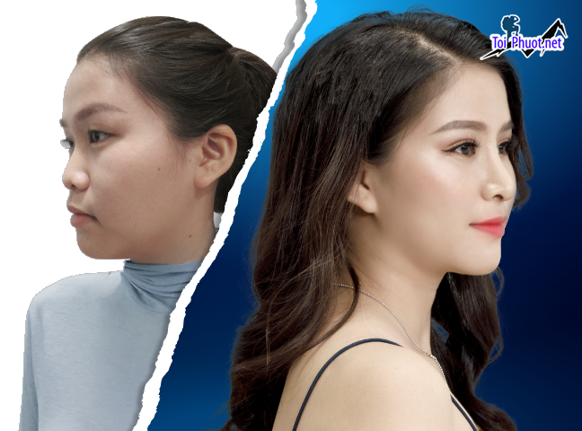 Top Địa chỉ Vĩnh Yên Vĩnh Phúc nâng mũi đẹp và an toàn nhất chuyên sâu (2)
